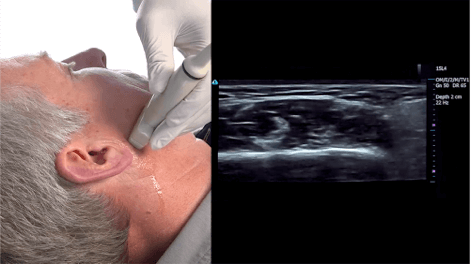 xeomin-injection-video-2